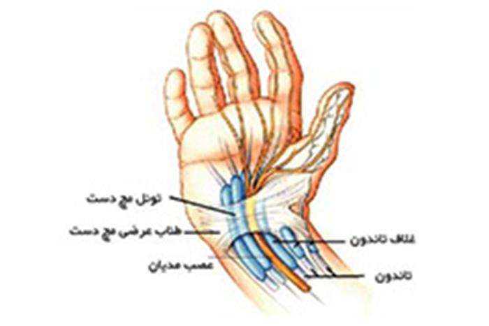 بیماری-سندروم-تونل-مچ-دست-در-ورزشکاران-چیست